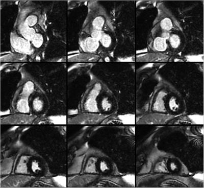 Sinus arrest in a p.Arg160X-DSP-positive patient without evidence of desmoplakin-mediated cardiomyopathy: a case report
